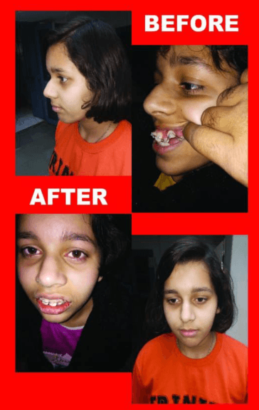Treatment Result