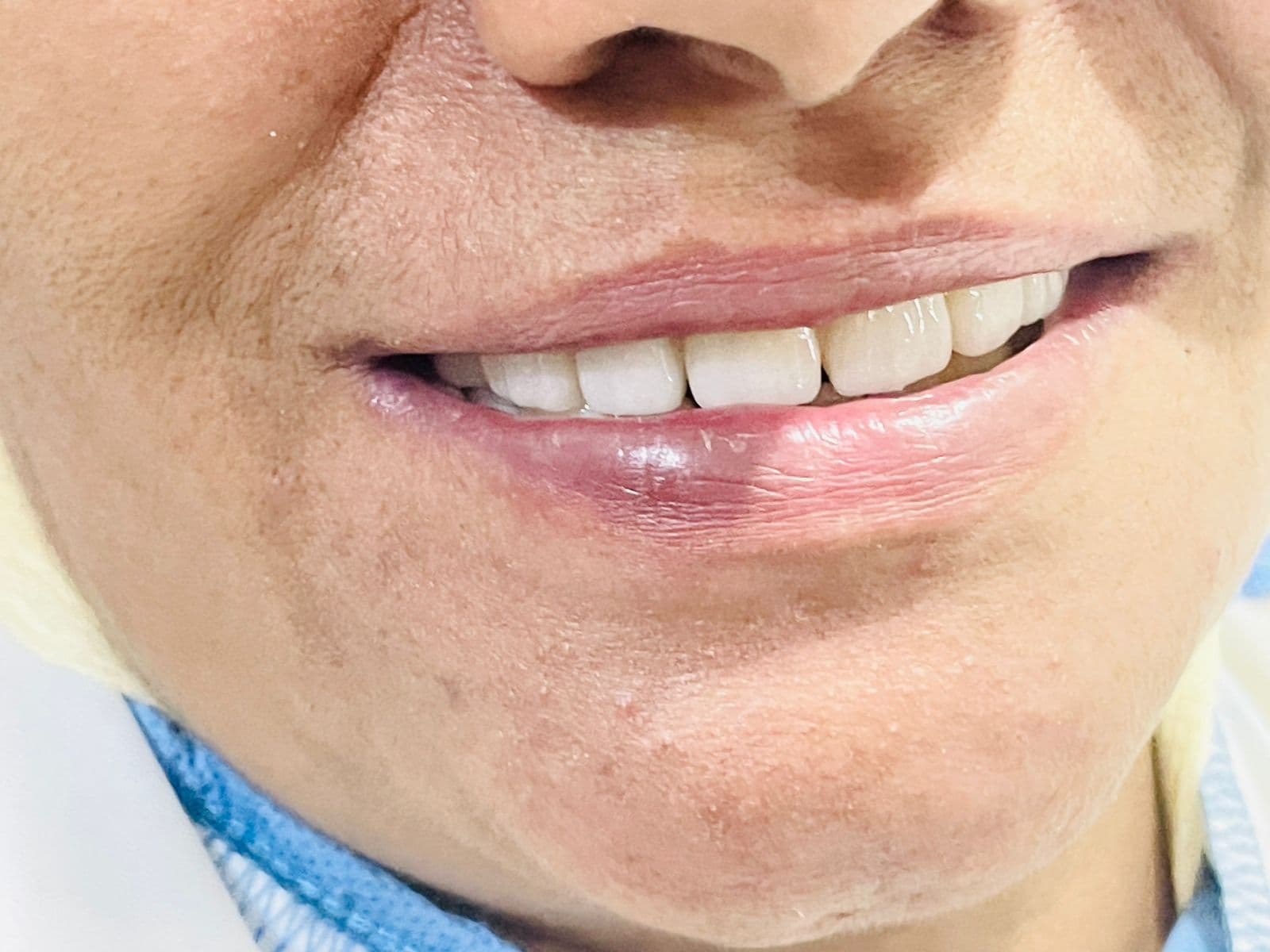 Smile Transformation