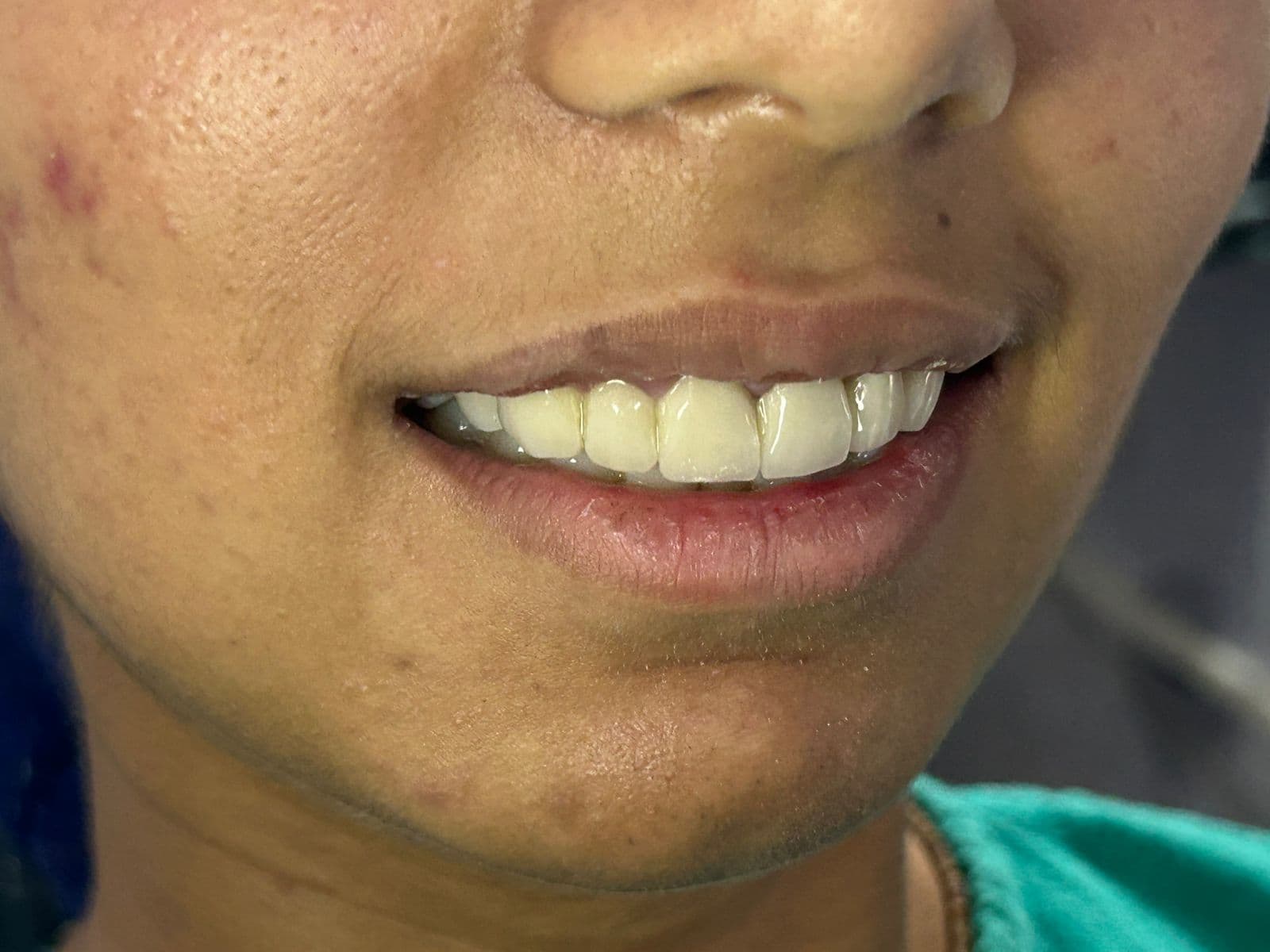 Smile Transformation