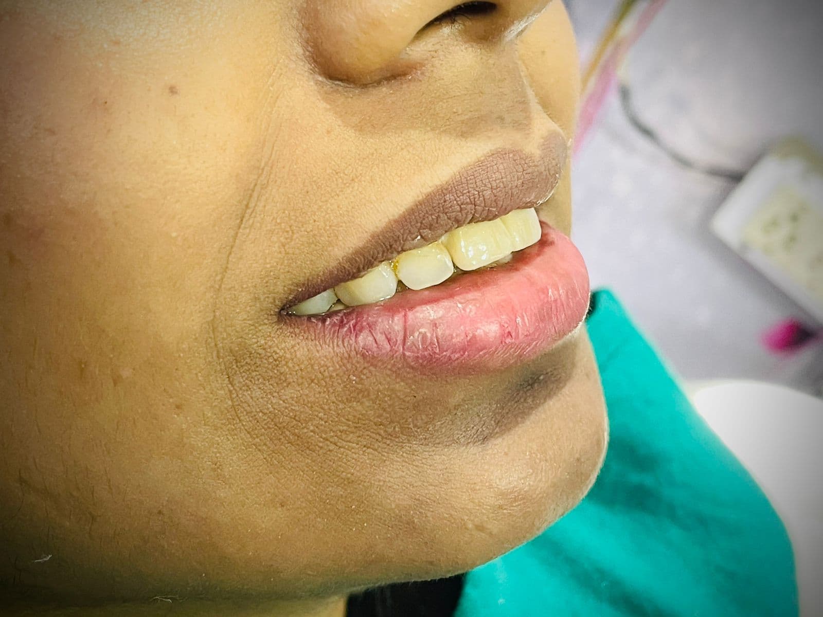 Smile Transformation