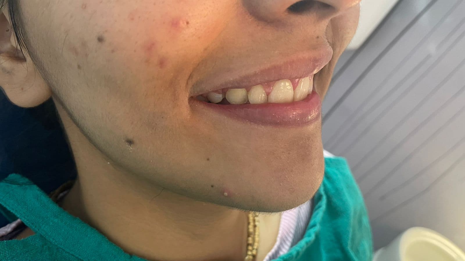 Smile Transformation