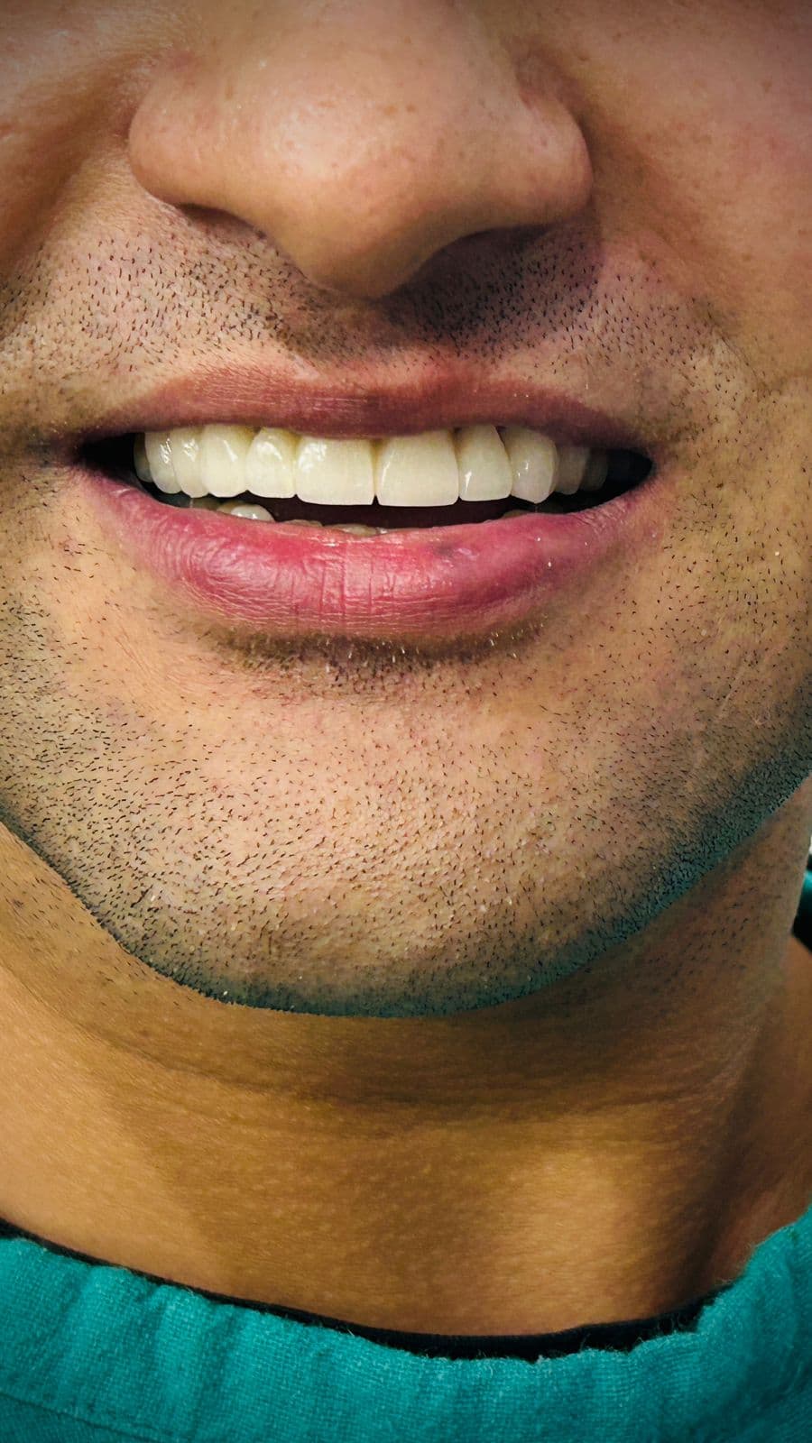 Smile Transformation