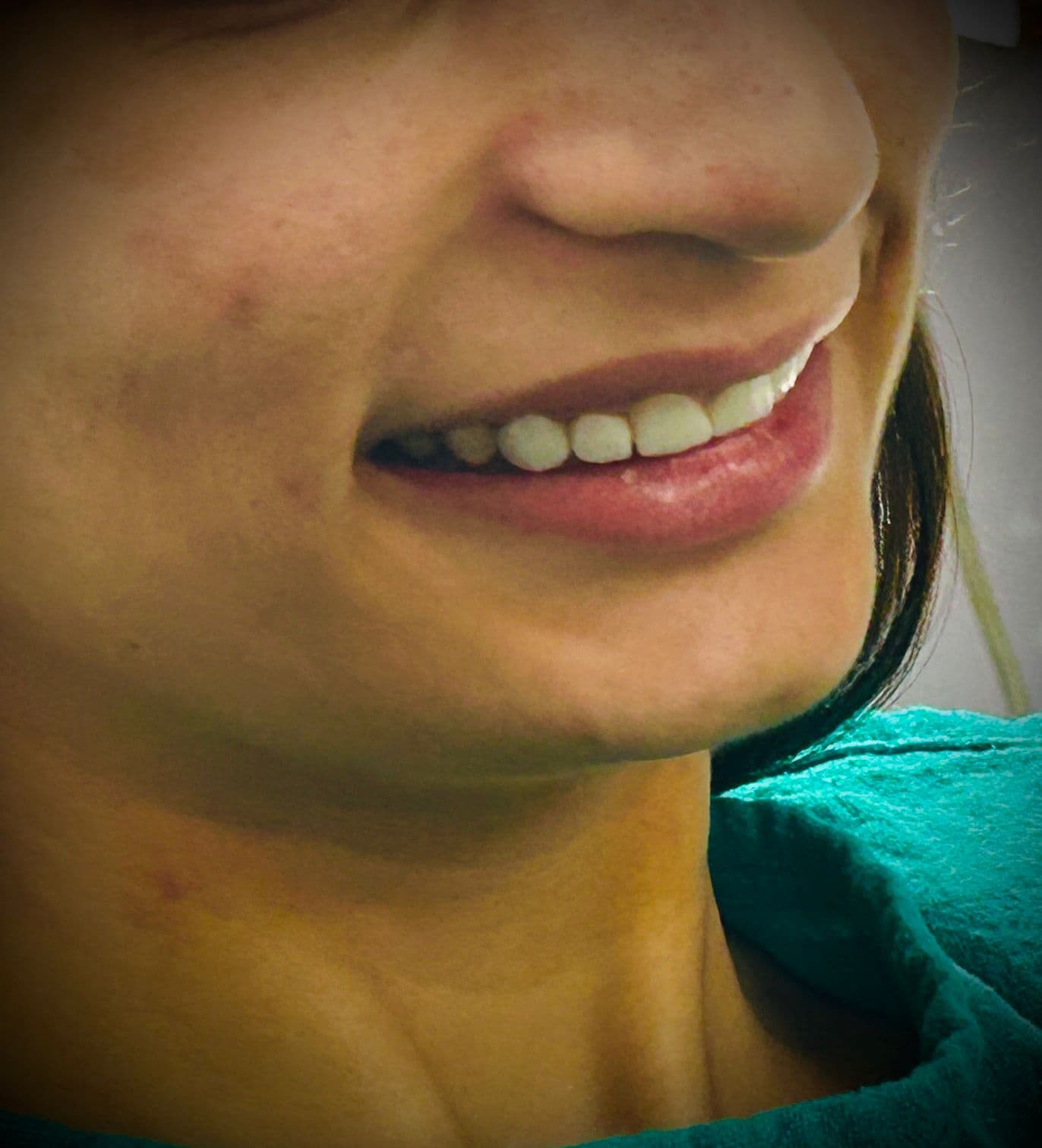Smile Transformation
